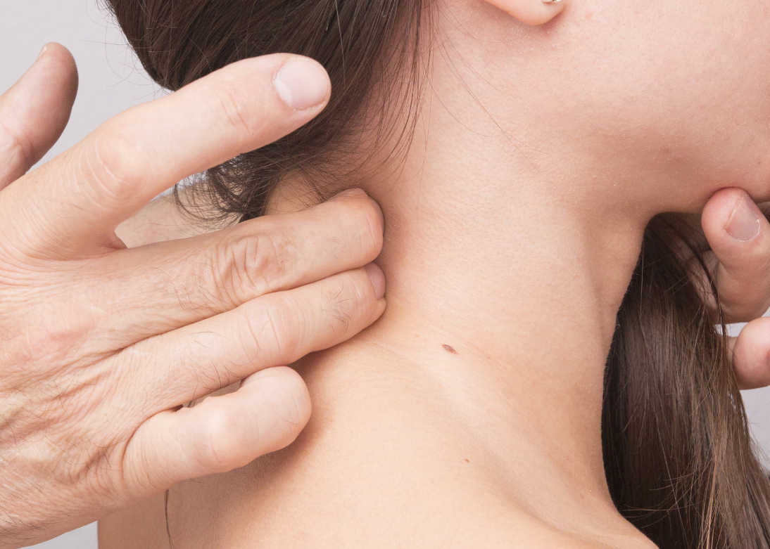Cervical Spondylosis